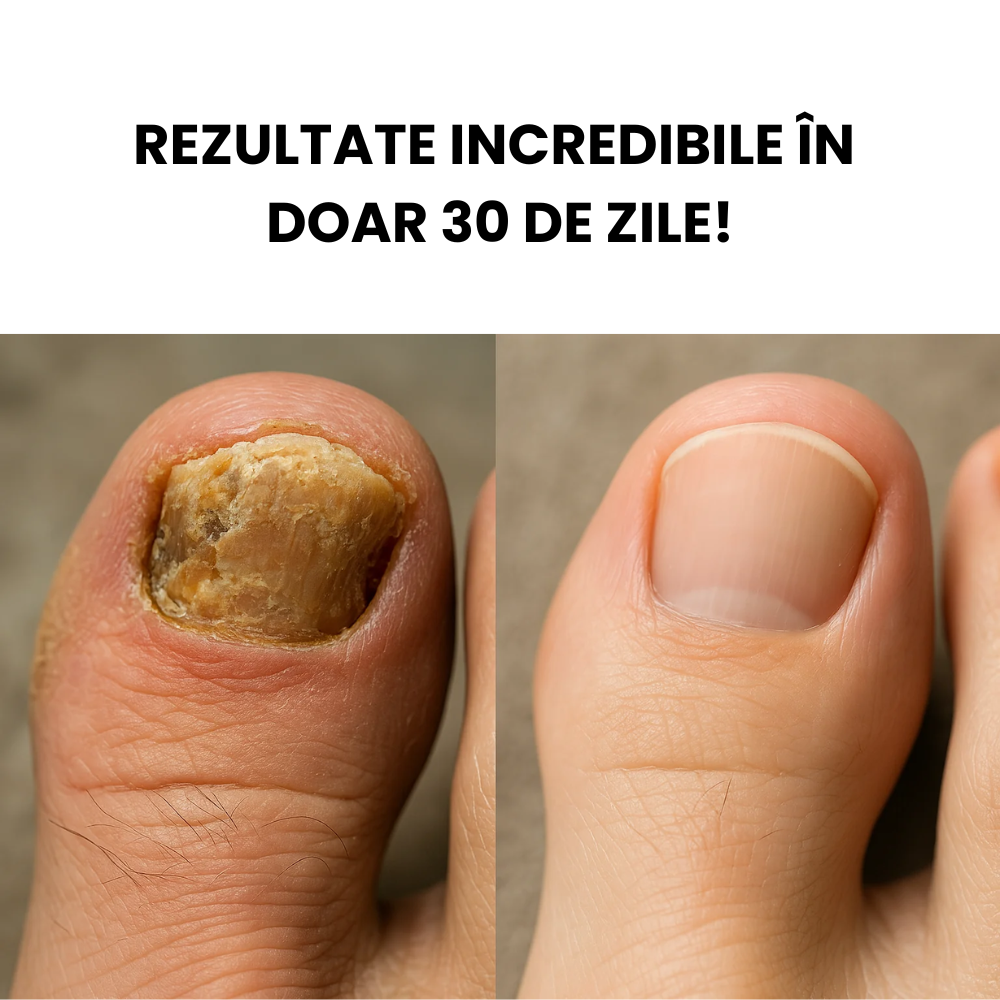 Tratament Reparator Anti-Fungic 10ml pentru Unghii Sănătoase